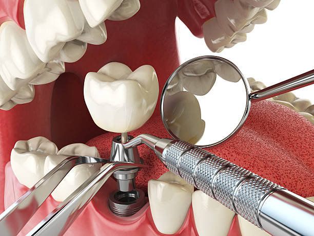 Best Emergency Dental Care for Broken or Chipped Teeth in Long Lake, MN